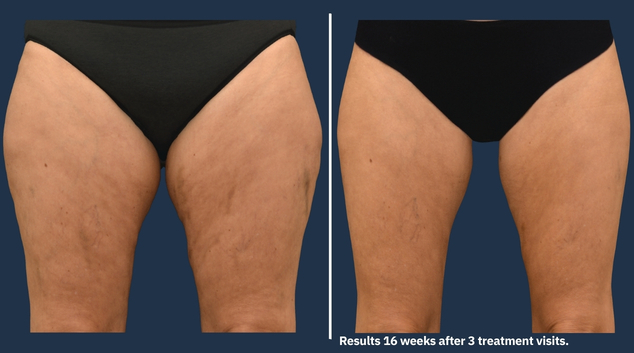 CoolSculpting Elite before and after thighs